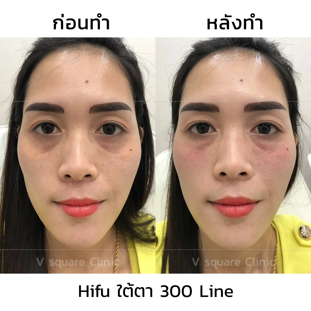 รีวิวทำHifuใต้ตา