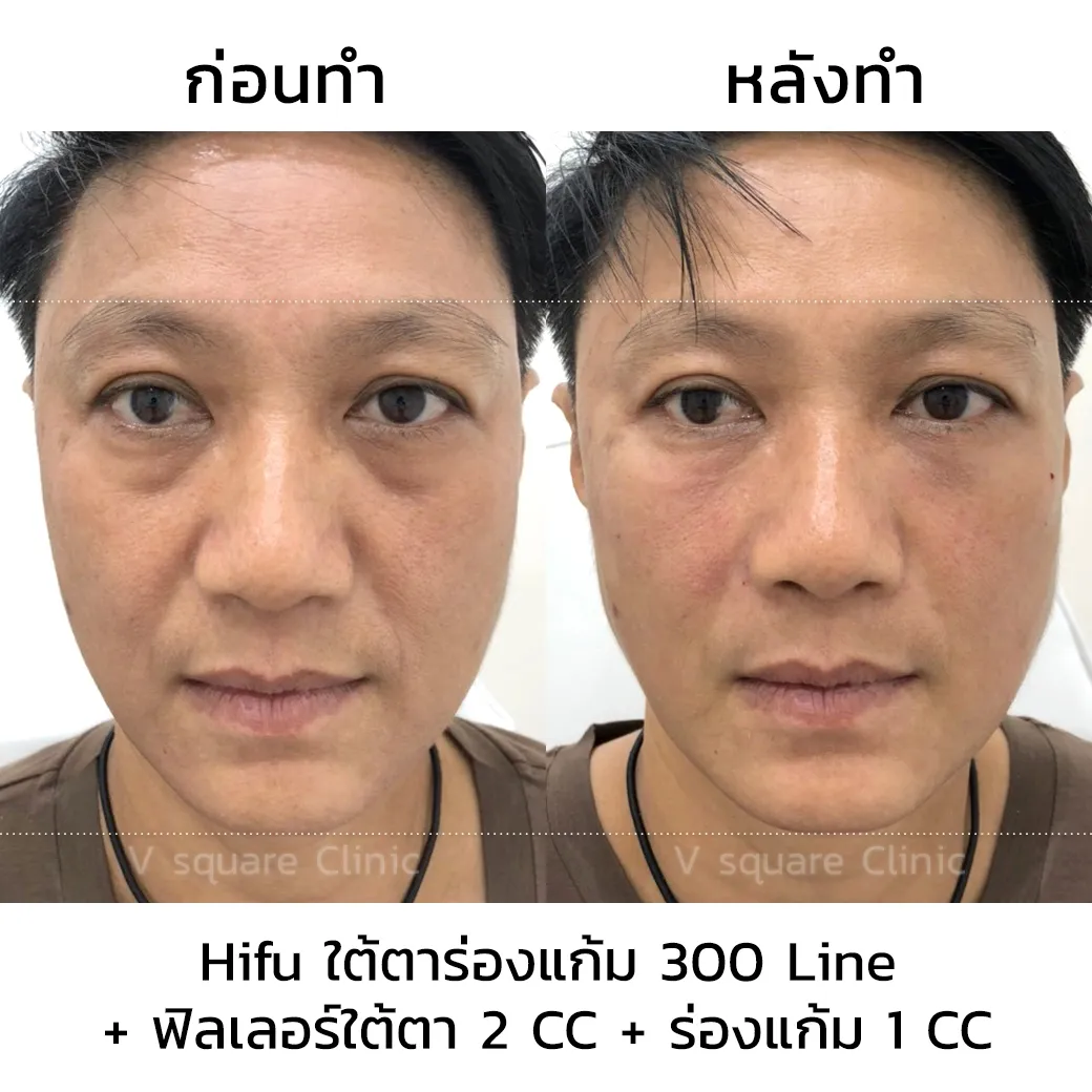 รีวิวทำHifuใต้ตาร่องแก้ม _ _