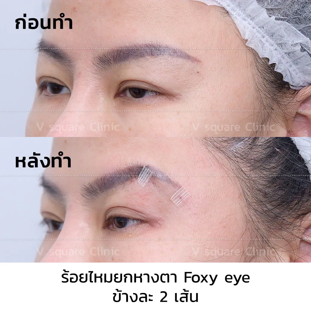 รีวิวร้อยไหม foxy eye_