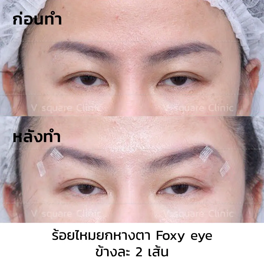 รีวิวร้อยไหม foxy eye_(1)