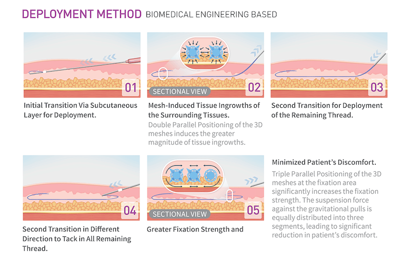 เทคนิคการร้อยไหมโครงตาข่าย