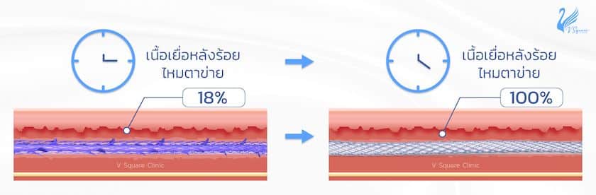 เนื้อเยื่อหลังร้อยไหมตาข่าย