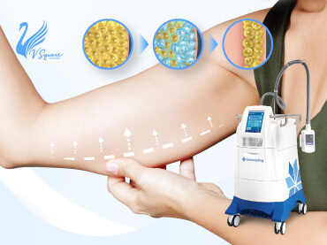 Coolsculpting-สลายไขมันต้นแขน370x277