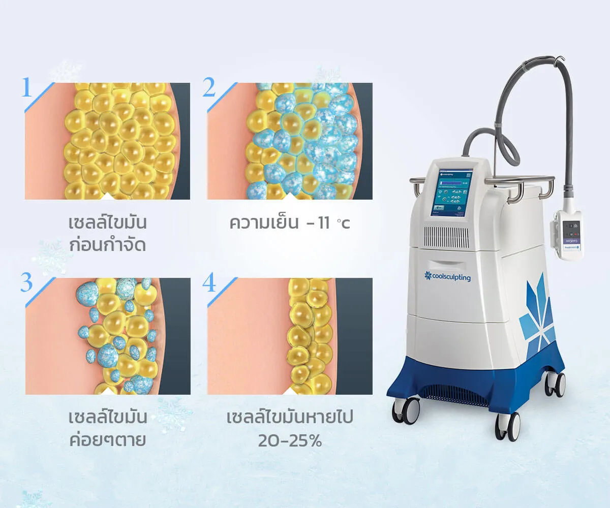 การทำงานCoolsculpting สลายไขมันต้นแขน