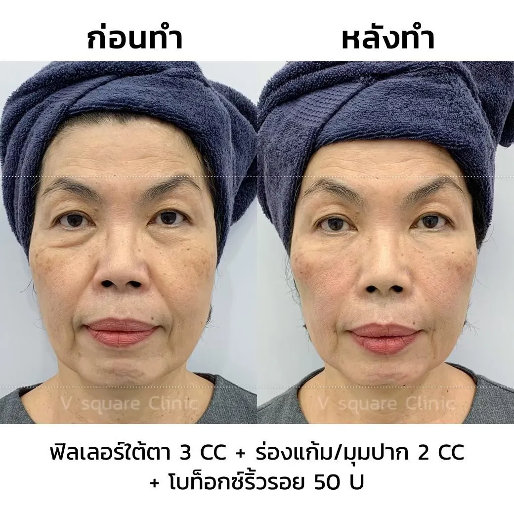 ฉีดฟิลเลอร์ยกมุมปาก