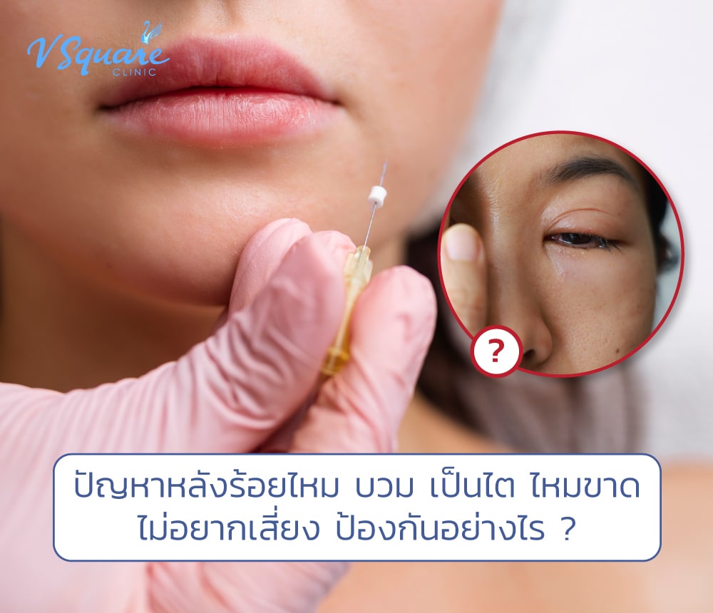 ปัญหาหลังร้อยไหม