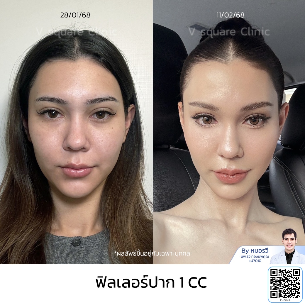 ฟิลเลอร์ปาก รีวิว_เอมี่