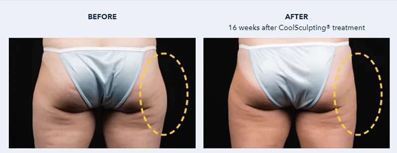 รีวิวCoolsculpting สลายไขมันต้นขา