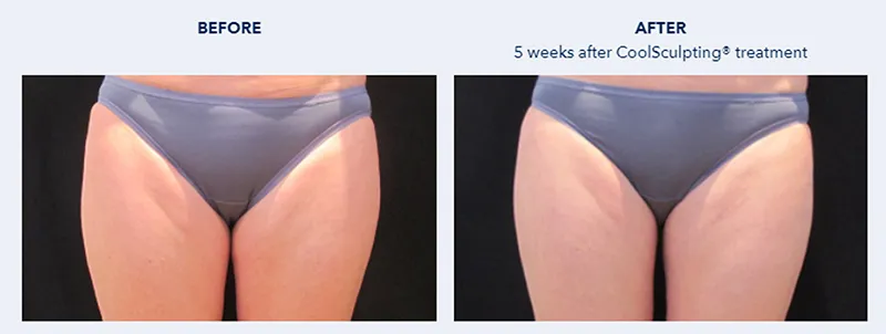 รีวิวCoolsculpting สลายไขมันต้นขา_1