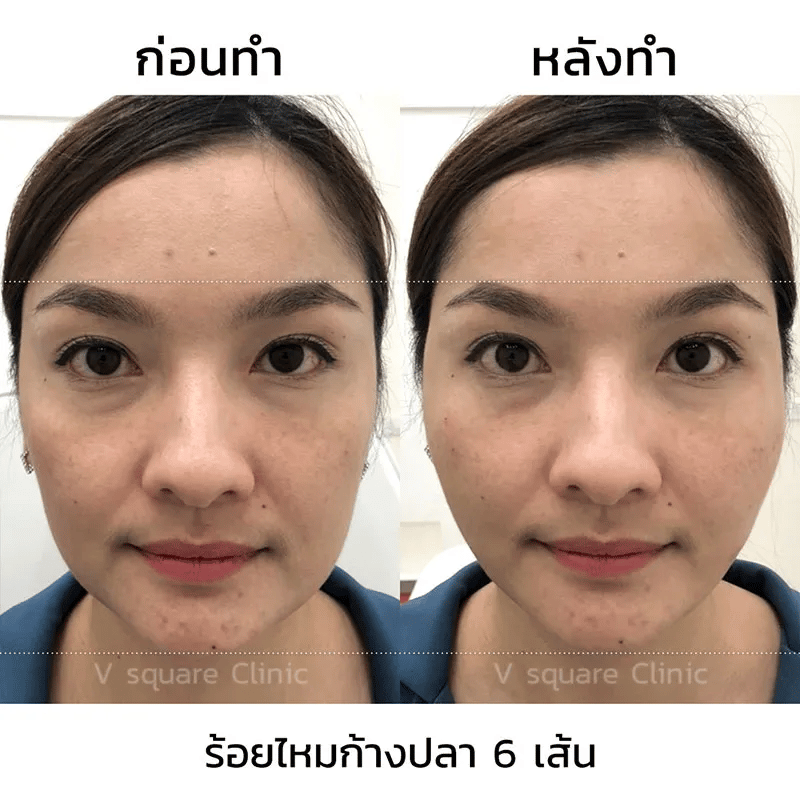 รีวิวหลังร้อยไหม