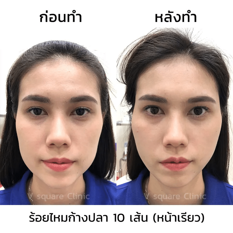 รีวิวหลังร้อยไหม