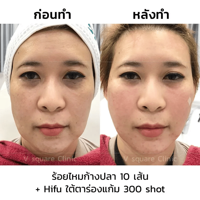 รีวิวหลังร้อยไหม