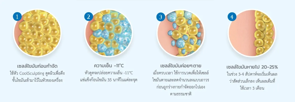 หลักการทำงาน Coolsculpting สลายไขมันต้นขา