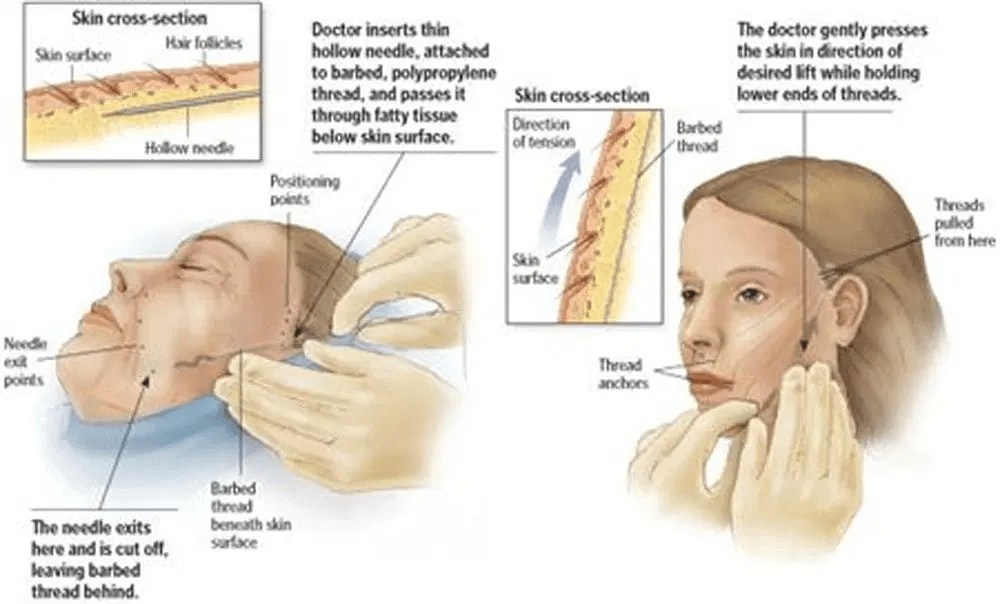 เทคนิคร้อยไหม
