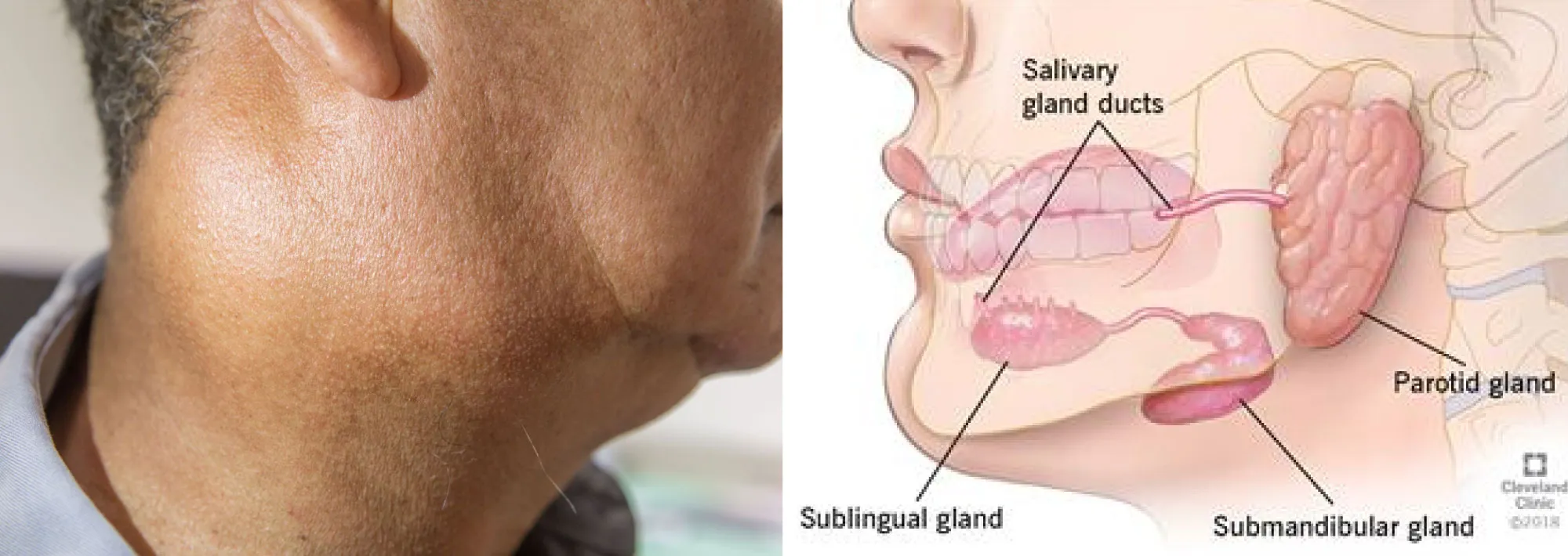 Parotid-gland-enlargement