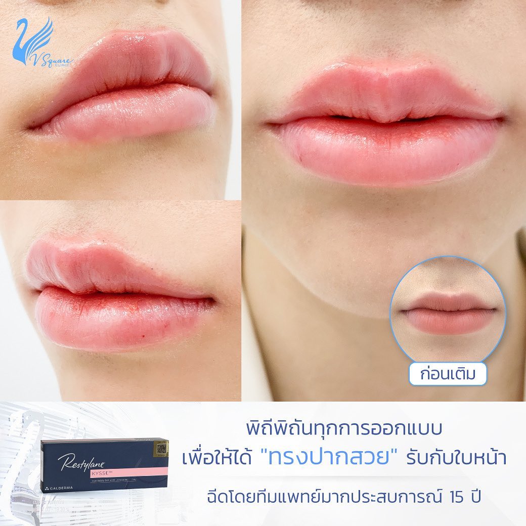 ฟิลเลอร์ Restylane Kysse