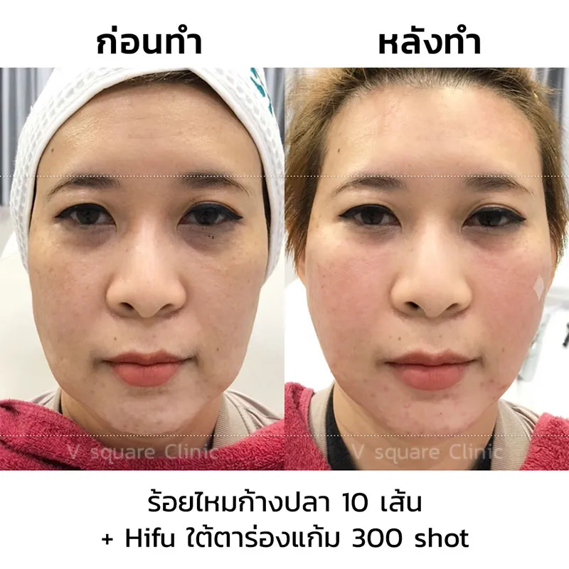 รีวิวร้อยไหม10 เส้น hifu 300 line