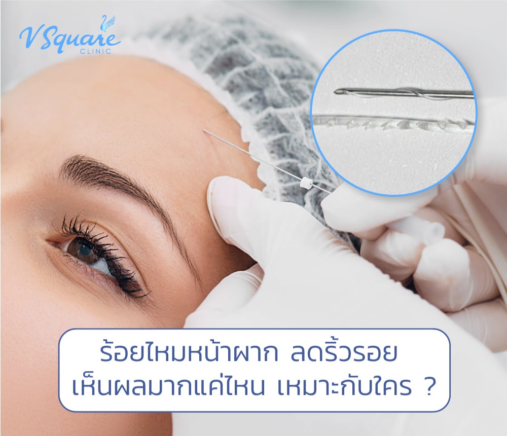 ร้อยไหมหน้าผาก