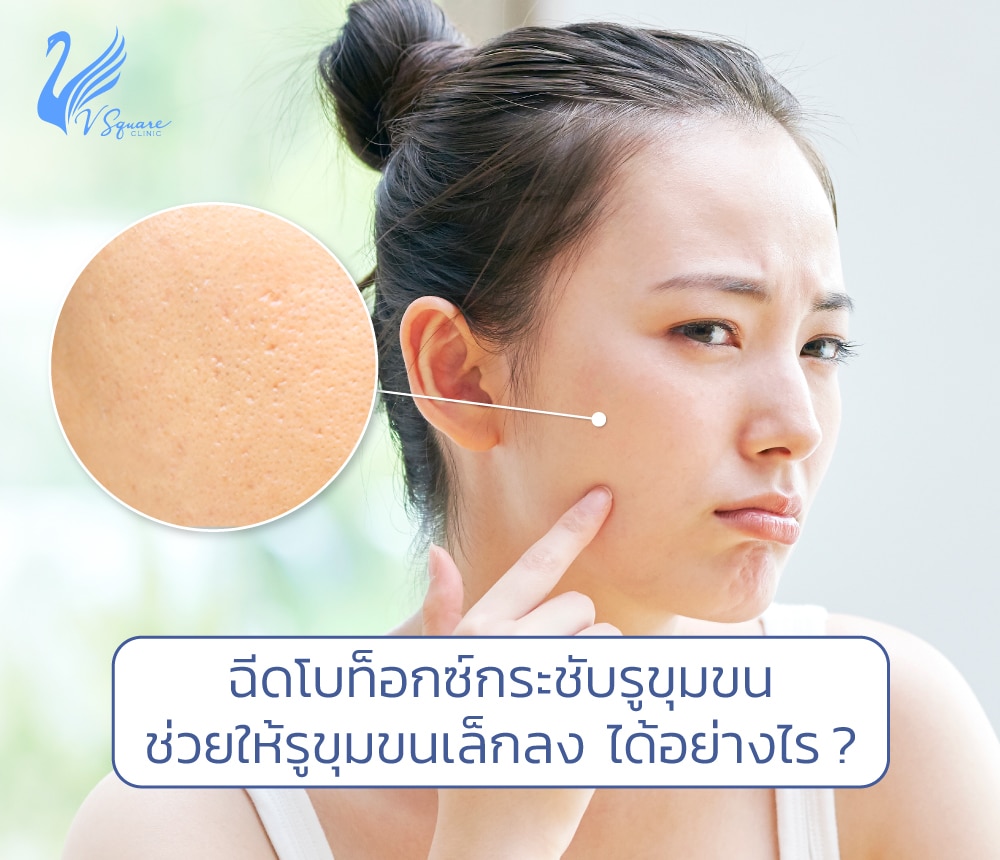 ฉีดโบท็อกกระชับรูขุมขน ช่วยให้รูขุมขนเล็กลงใบหน้าเรียบเนียน เห็นผลจริงไหม? ฉีดโบท็อกกระชับรูขุมขน ช่วยให้รูขุมขนเล็กลงใบหน้าเรียบเนียน เห็นผลจริงไหม?