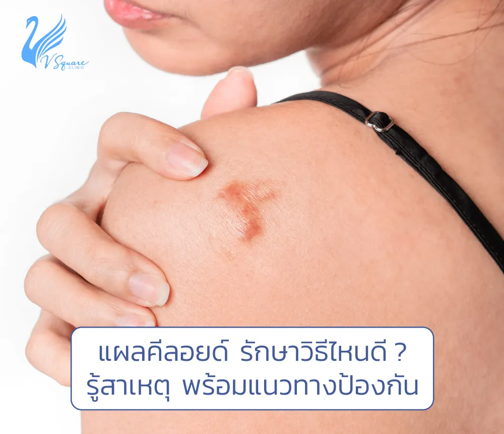 แผลเป็นคีลอยด์คืออะไร เกิดจากสาเหตุใด ? รักษาวิธีไหนดี ? ที่นี่มีคำตอบ แผลเป็นคีลอยด์คืออะไร เกิดจากสาเหตุใด ? รักษาวิธีไหนดี ? ที่นี่มีคำตอบ