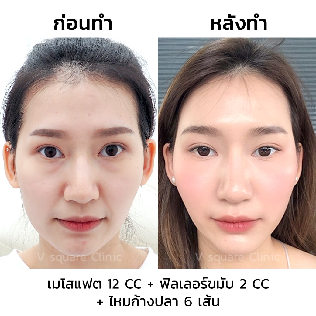 รีวิว ฉีดฟิลเลอร์ขมับ 2 CC