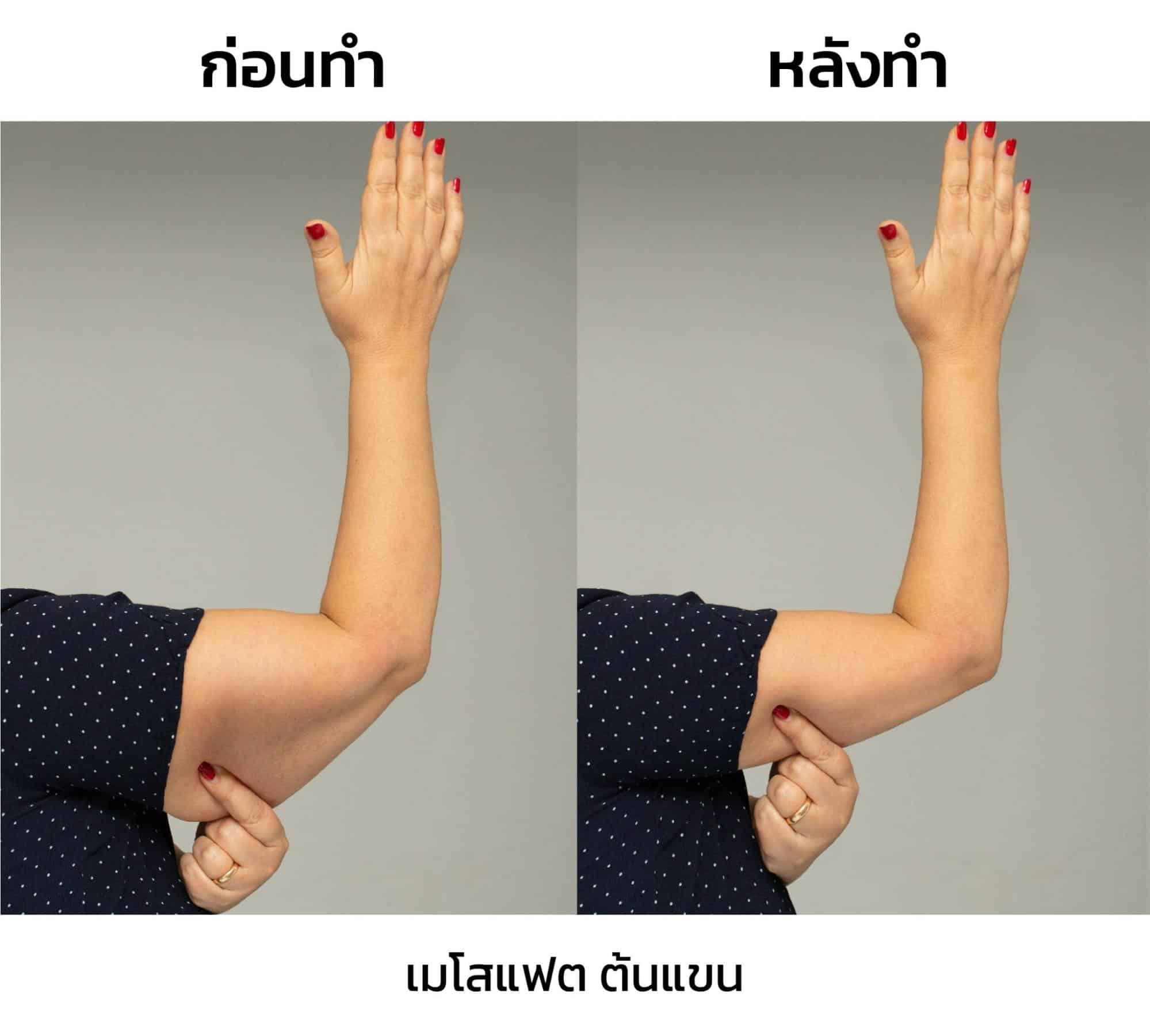 รีวิว ฉีดเมโสแฟตลดต้นแขน