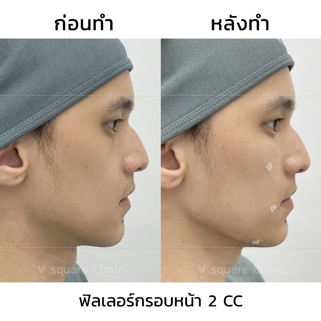 รีวิวฉีดฟิลเลอร์กรอบหน้า 2 CC