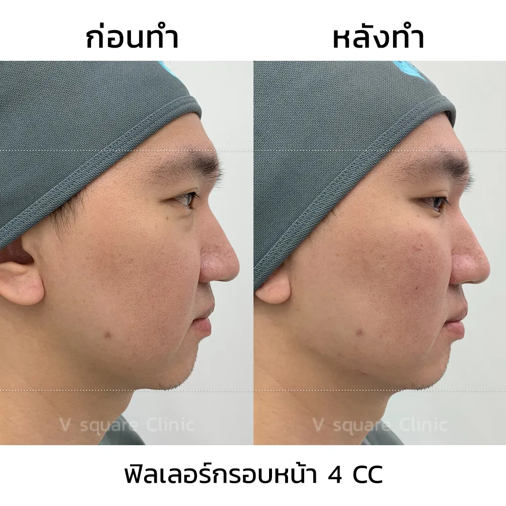 รีวิวฉีดฟิลเลอร์กรอบหน้า 4 CC