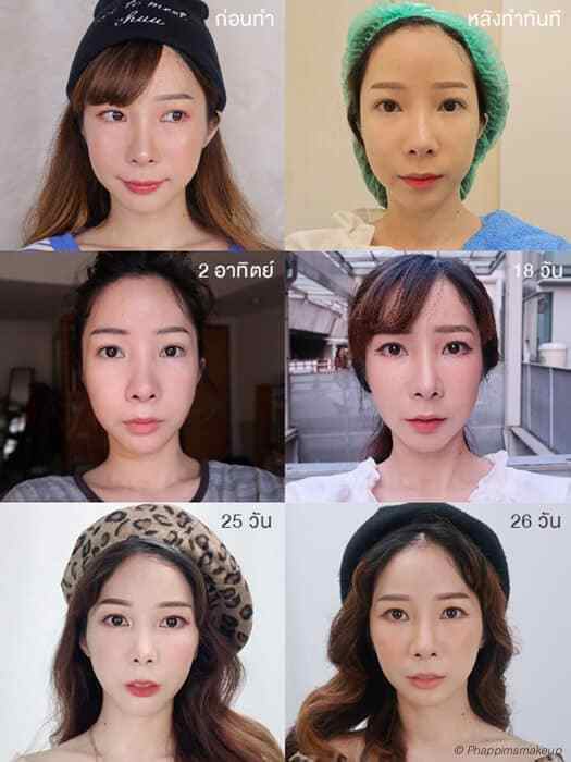 รีวิวผลลัพธ์หลังทำ Hifu