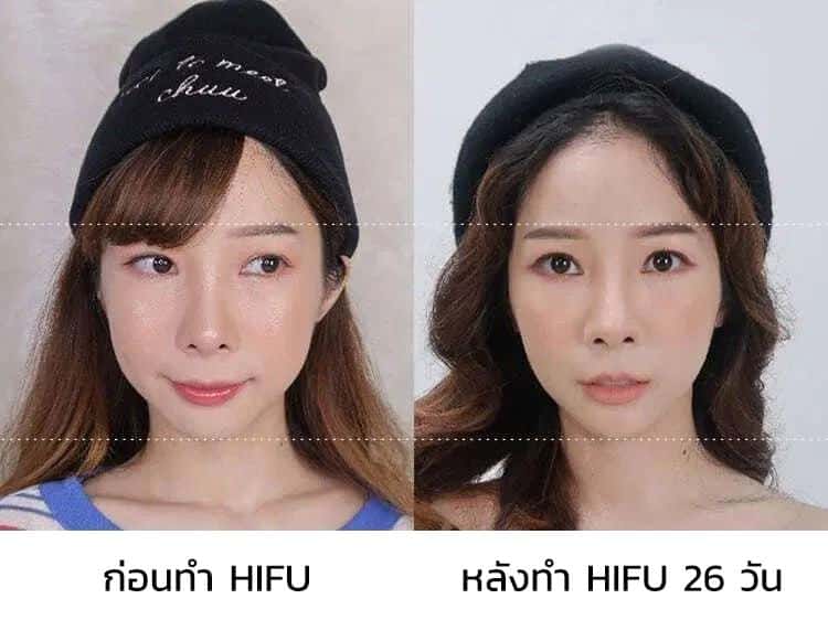 รีวิวผลลัพธ์หลังทำ Hifu