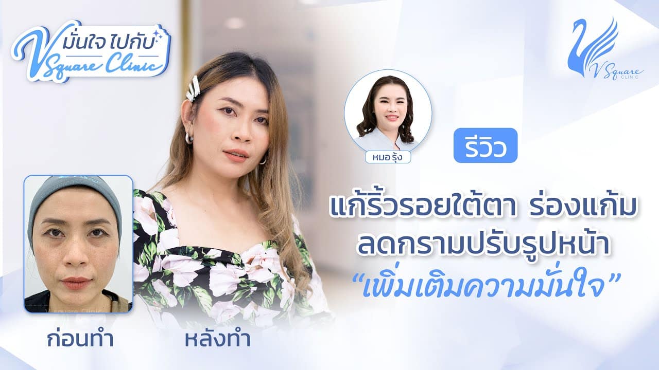 ฉีดฟิลเลอร์ใต้ตา-ฟิลเลอร์ร่องแก้ม-by-หมอรุ้ง