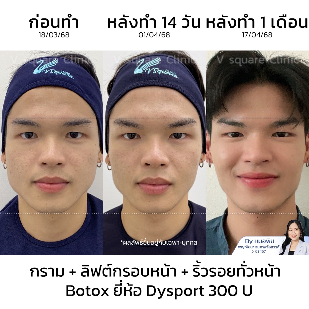 ฉีดโบท็อก รีวิว_คุณบอส
