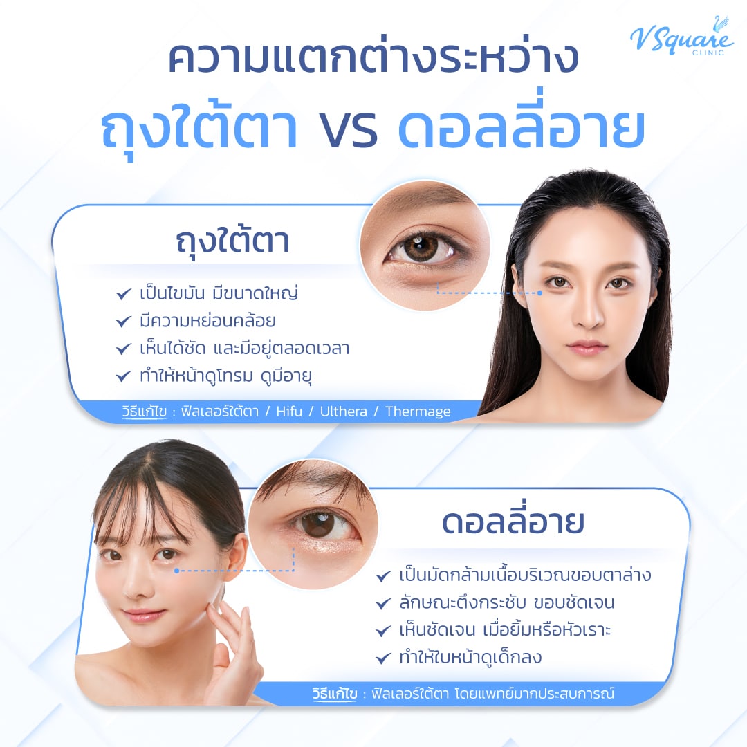 ถุงใต้ตา VS ดอลลี่อาย