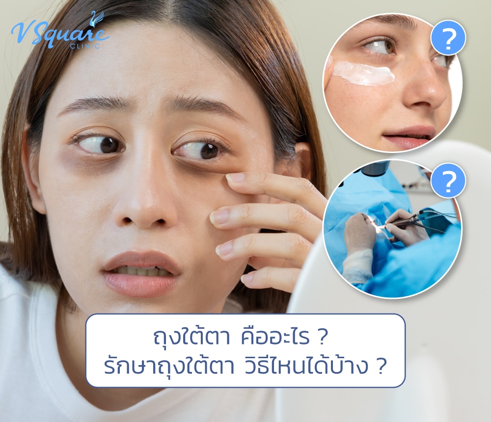 ถุงใต้ตา