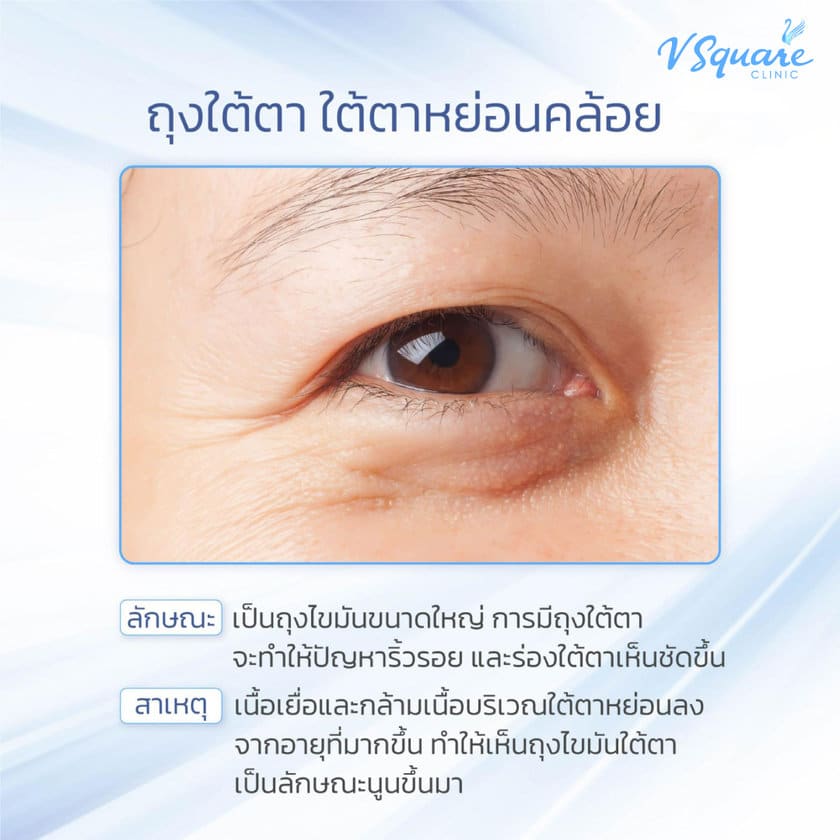 ปัญหาถุงใต้ตา