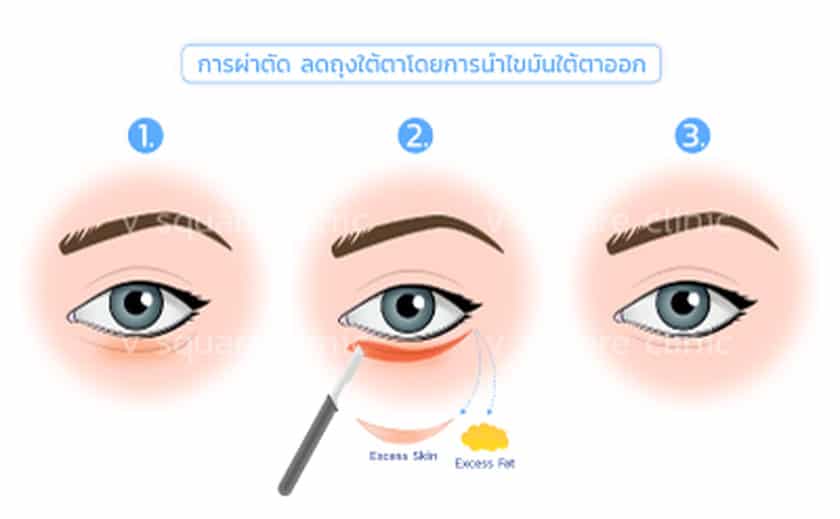 ผ่าตัดถุงใต้ตา