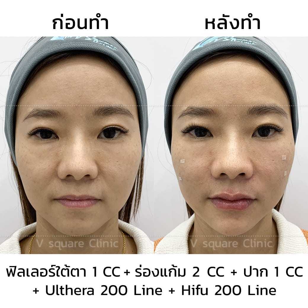 รีวิว UltheraSPT200line