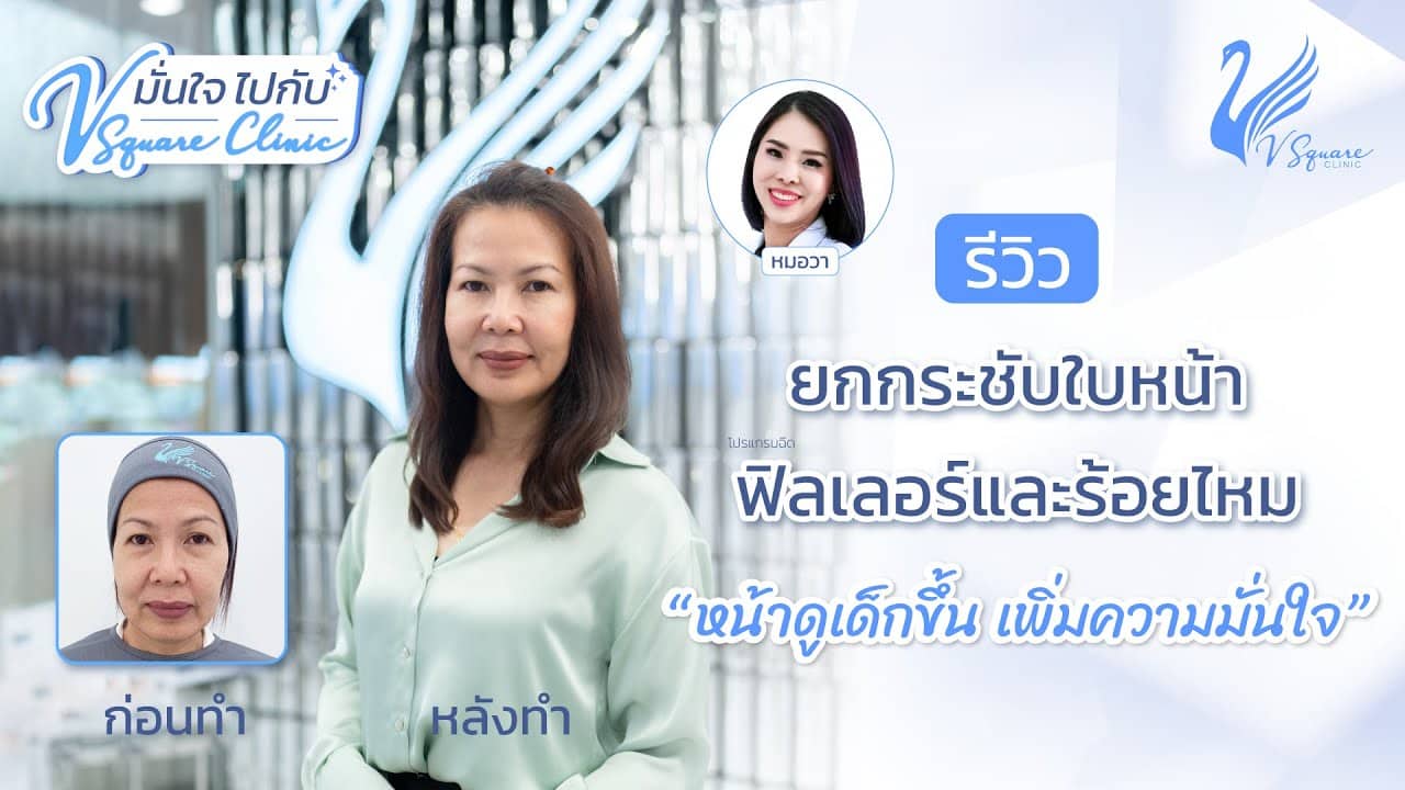 รีวิวฉีดฟิลเลอร์ ร้อยไหม แก้ไขโครงหน้าทรุด ขมับตอบ ร่องแก้มลึก