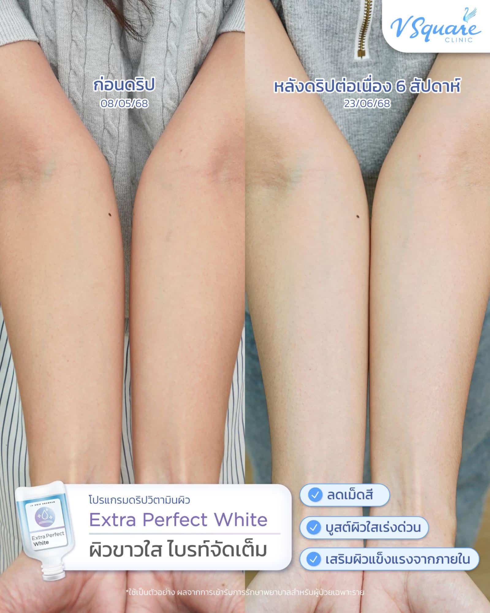 รีวิวฉีดวิตามินผิว