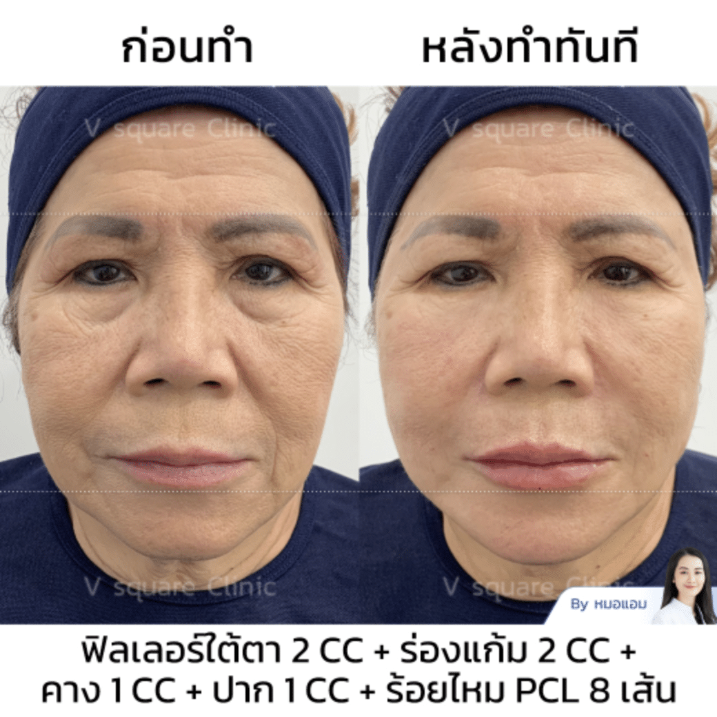 รีวิวร้อยไหม_คุณหมวย