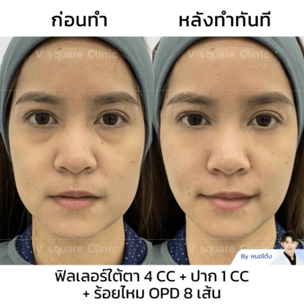 รีวิวร้อยไหม_พี่เก่ง