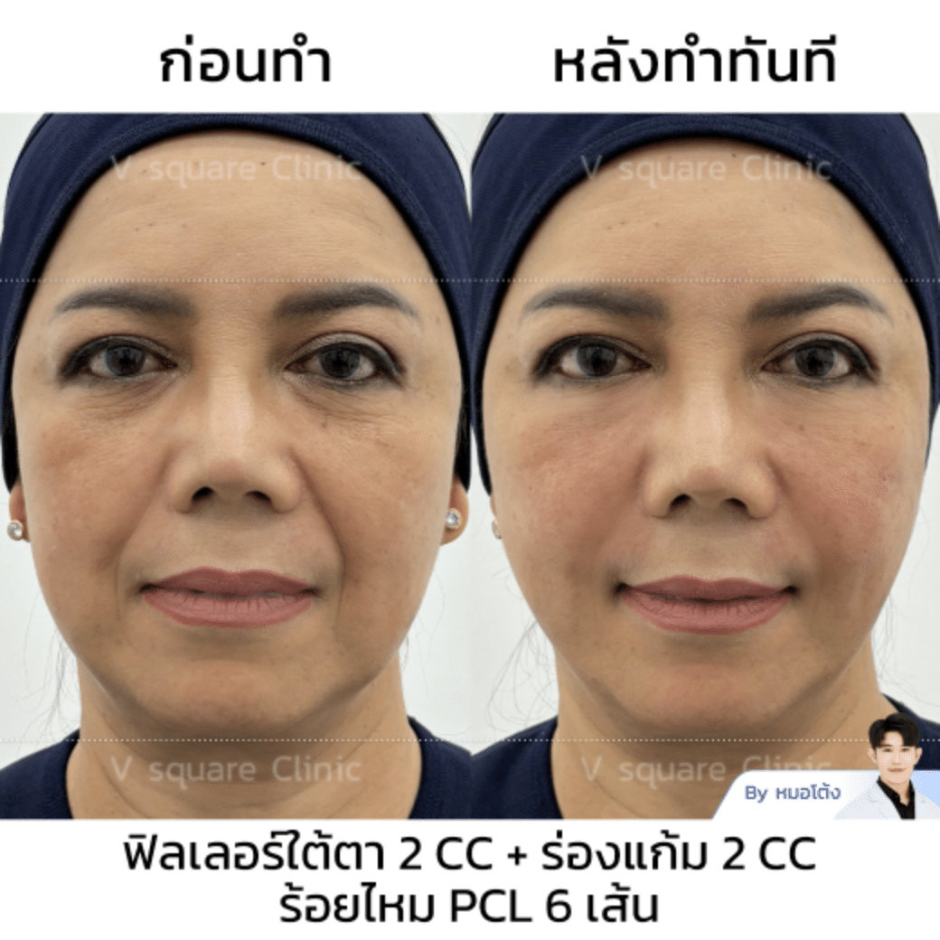 รีวิวร้อยไหม_แม่เปิ้ล