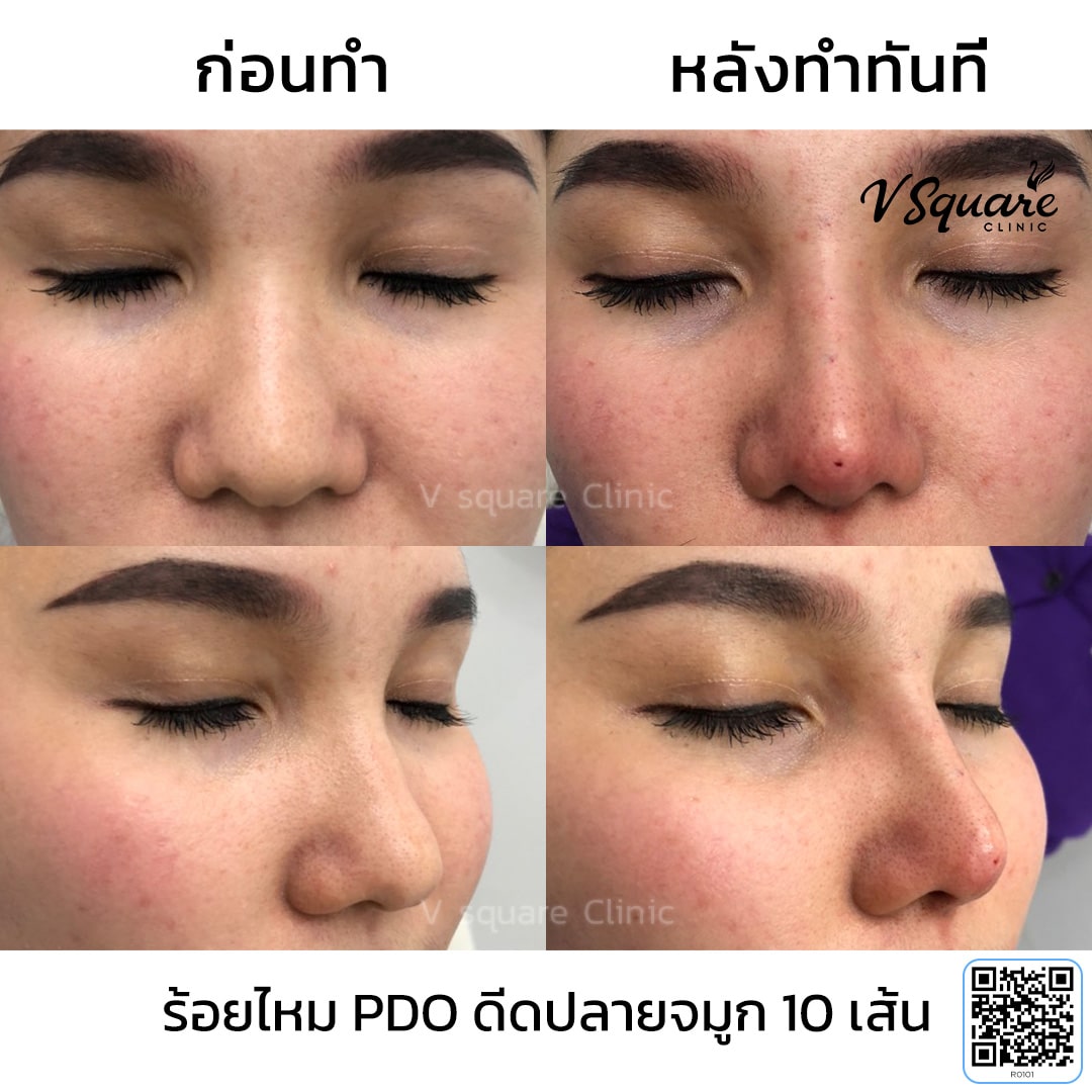 รีวิวร้อยไหมจมูก_R0101