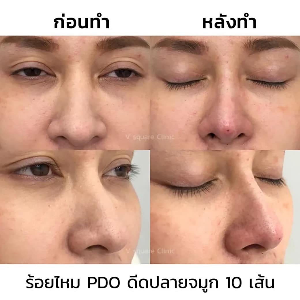 รีวิวร้อยไหมจมูกปรับทรงจมูกให้โด่ง