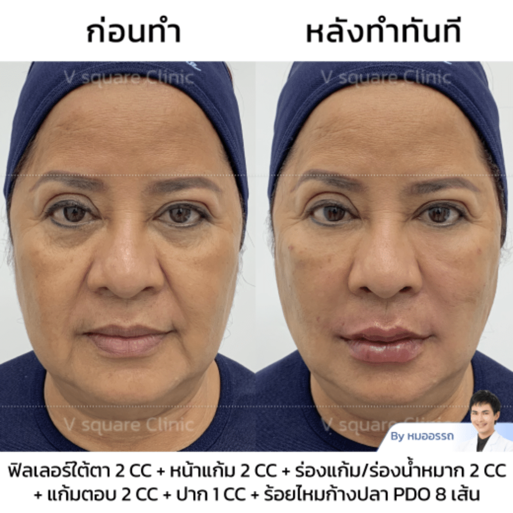 รีวิวร้อยไหมปรับรูปหน้า_คุณโนกิ