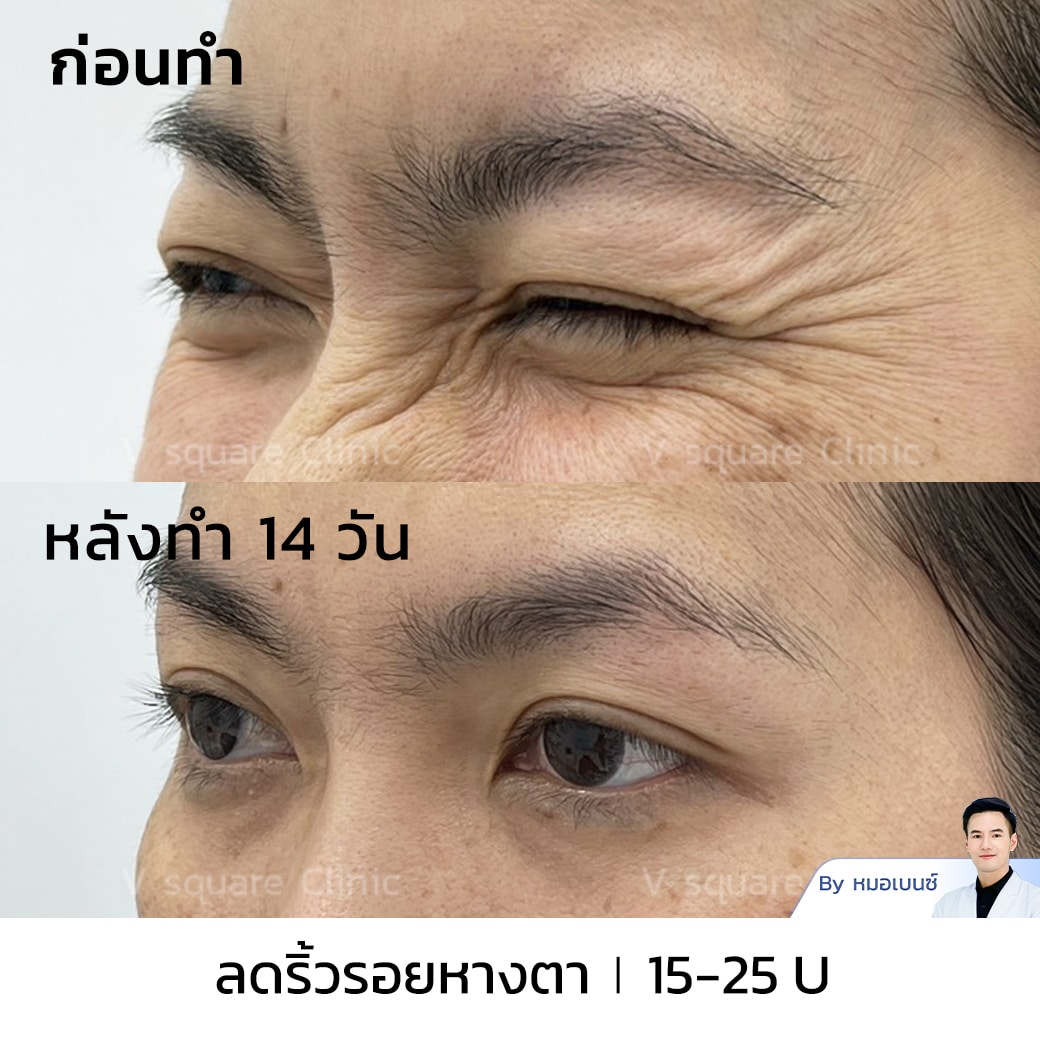 รีวิวโบท็อกริ้วรอย_คุณจุฑามาศ