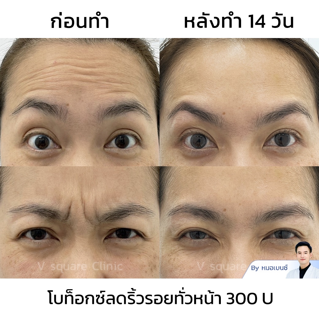 รีวิวโบท็อกริ้วรอย_คุณจุฑามาศ