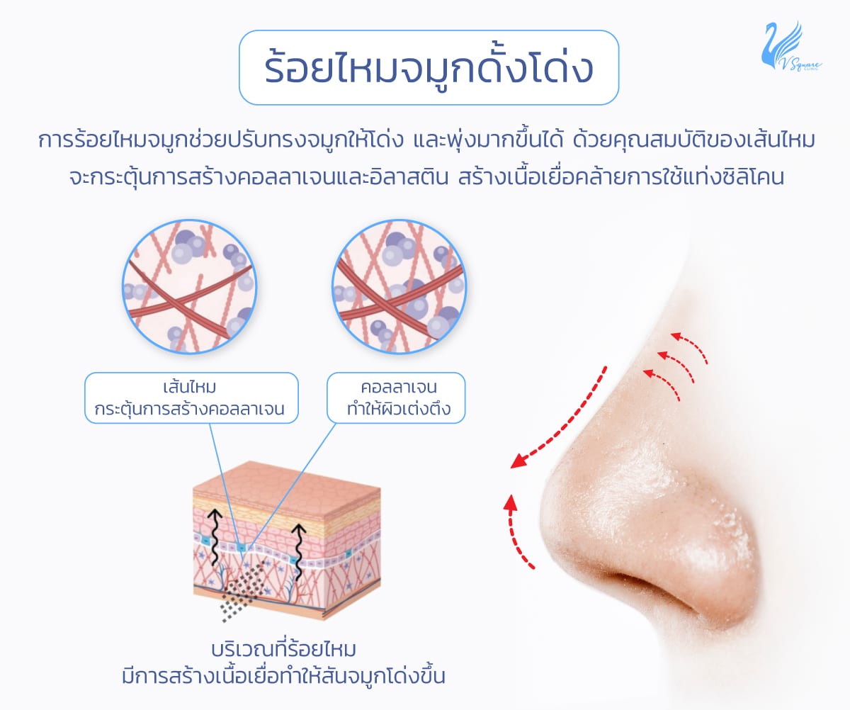 ร้อยไหมจมูกดั้งโด่ง