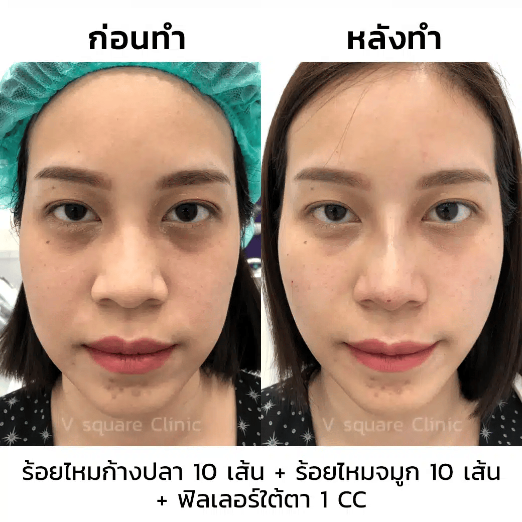 ร้อยไหมจมูกรีวิว