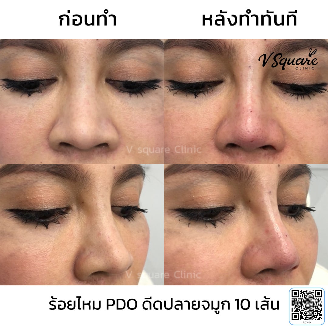ร้อยไหมจมูกรีวิว_R0100